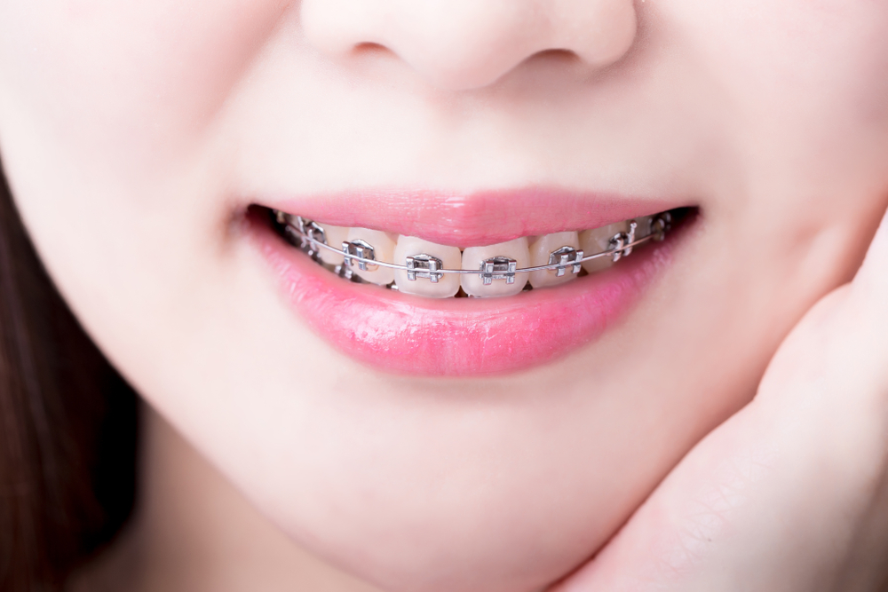 fixed braces, traditional braces Fixed Braces shutterstock 1039572298 1