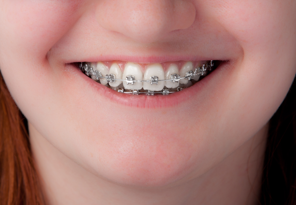 fixed braces, traditional braces Fixed Braces shutterstock 118421881