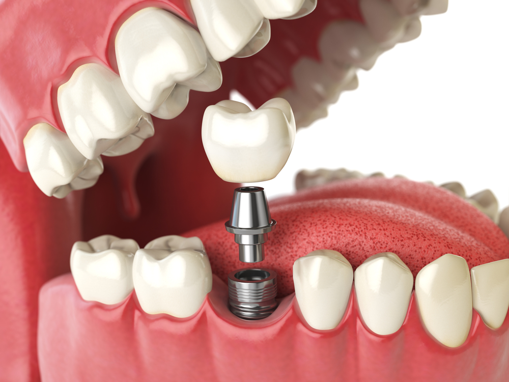 dental implants, tooth implants Dental Implants & Crowns shutterstock 447016423