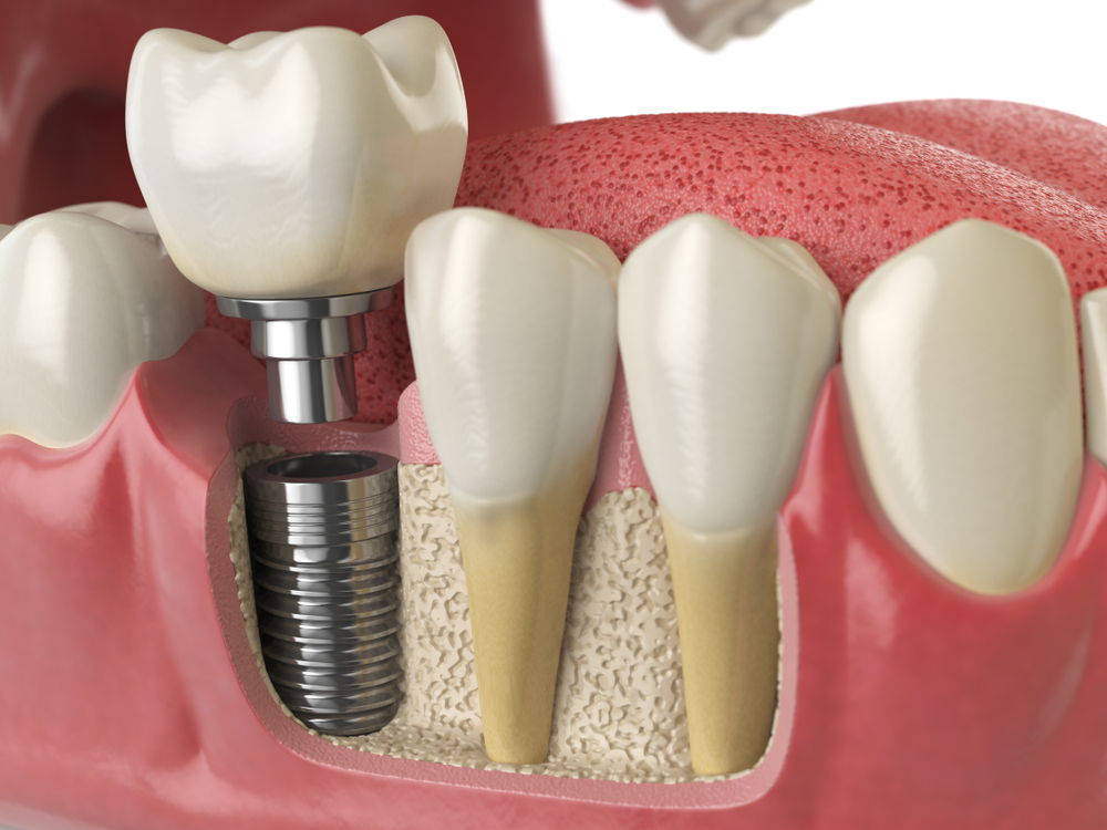 dental implants, tooth implants Dental Implants & Crowns shutterstock 767861803