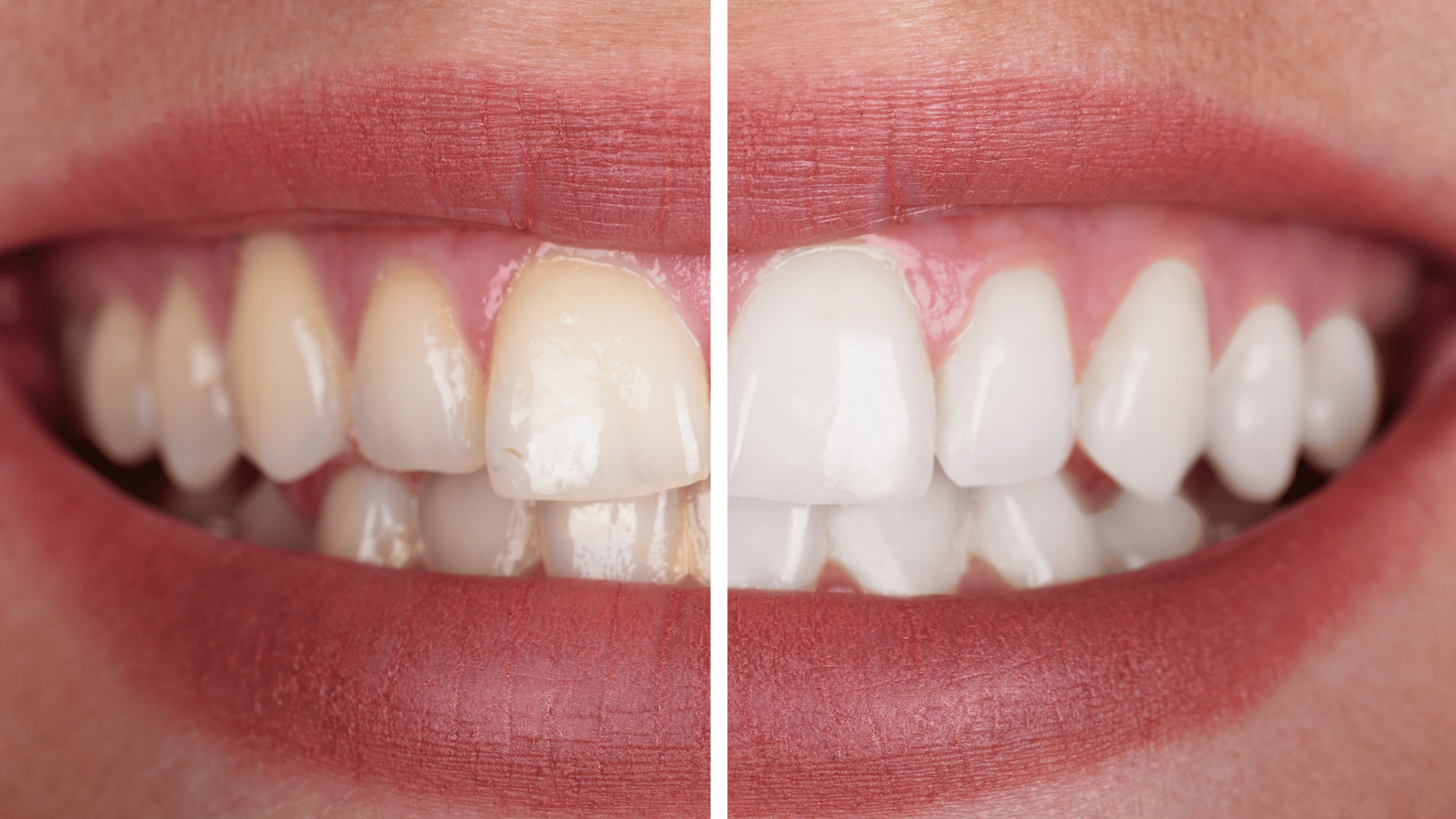 dentist Teeth Whitening | Top Recommended in London BGO 3