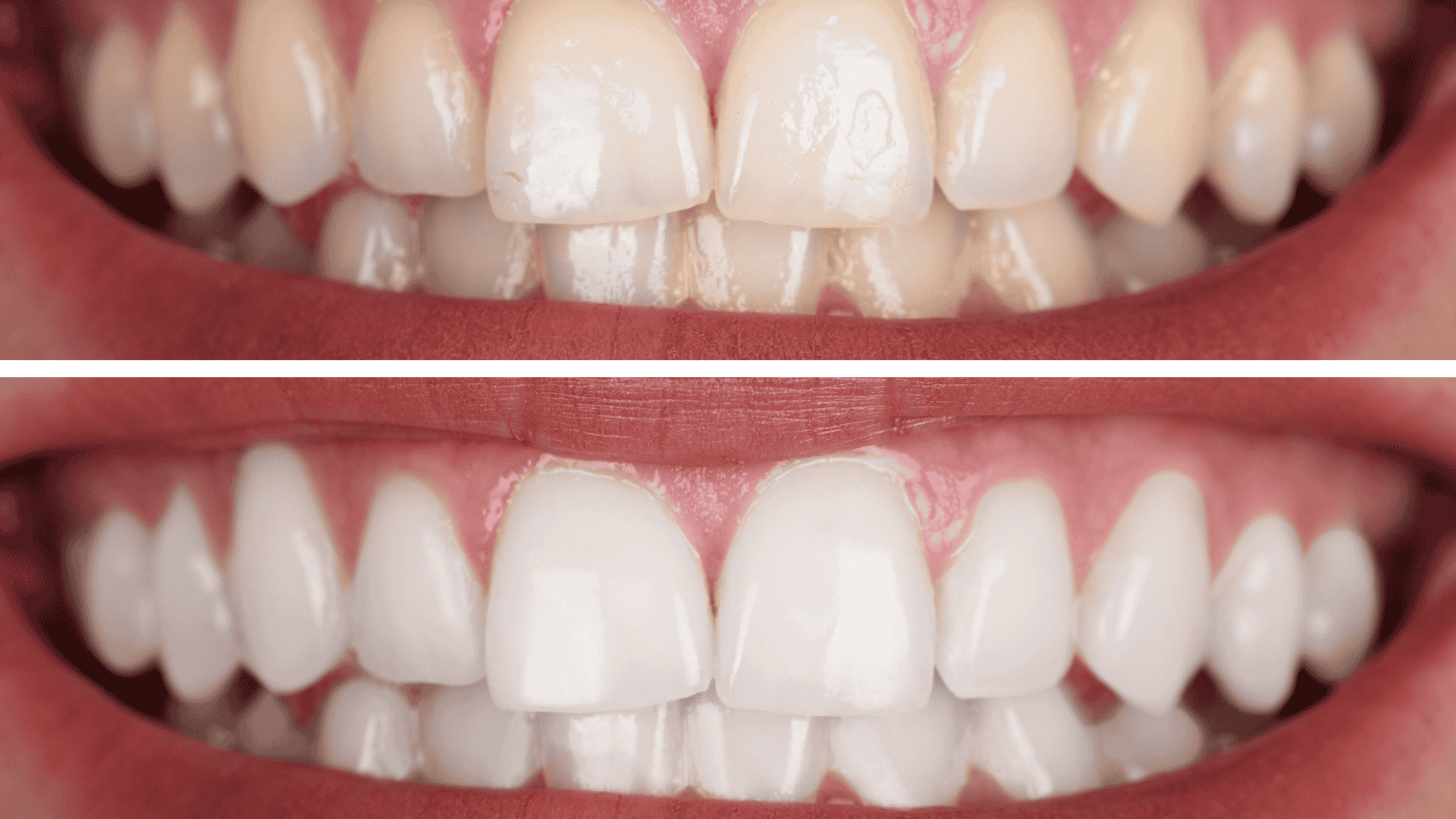 Teeth Whitening | Top #1 Dentists in London | BGO