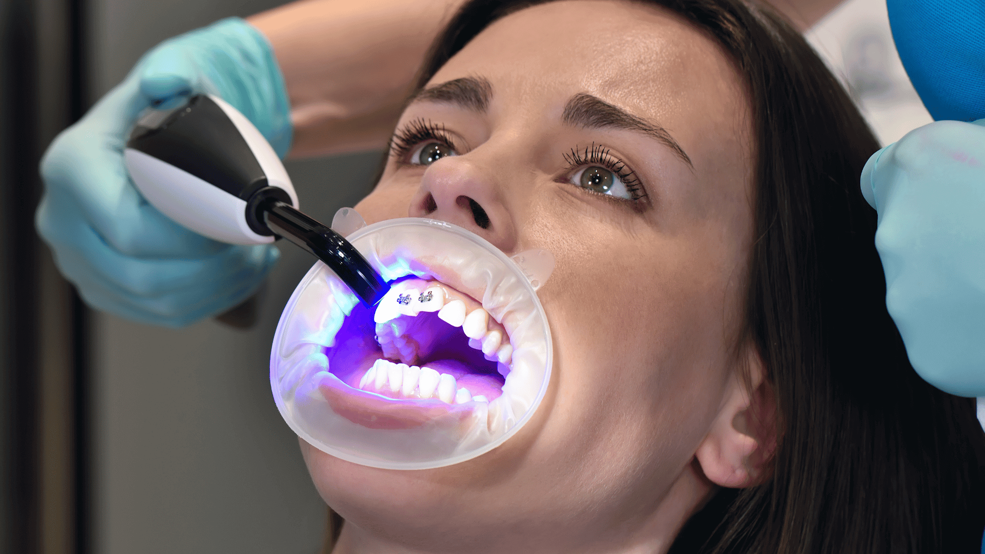 Fixed braces by the top #1 dentists in London at Buckingham Gate Orthodontics. Effective, comfortable, and tailored orthodontic care. Book your consultation now!