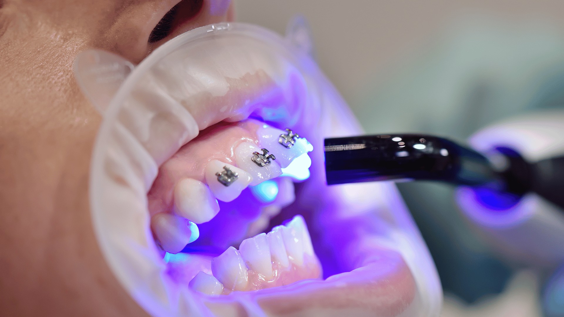 Discover affordable fixed braces at Buckingham Gate Orthodontics, London’s top choice for stunning smiles at the lowest prices.