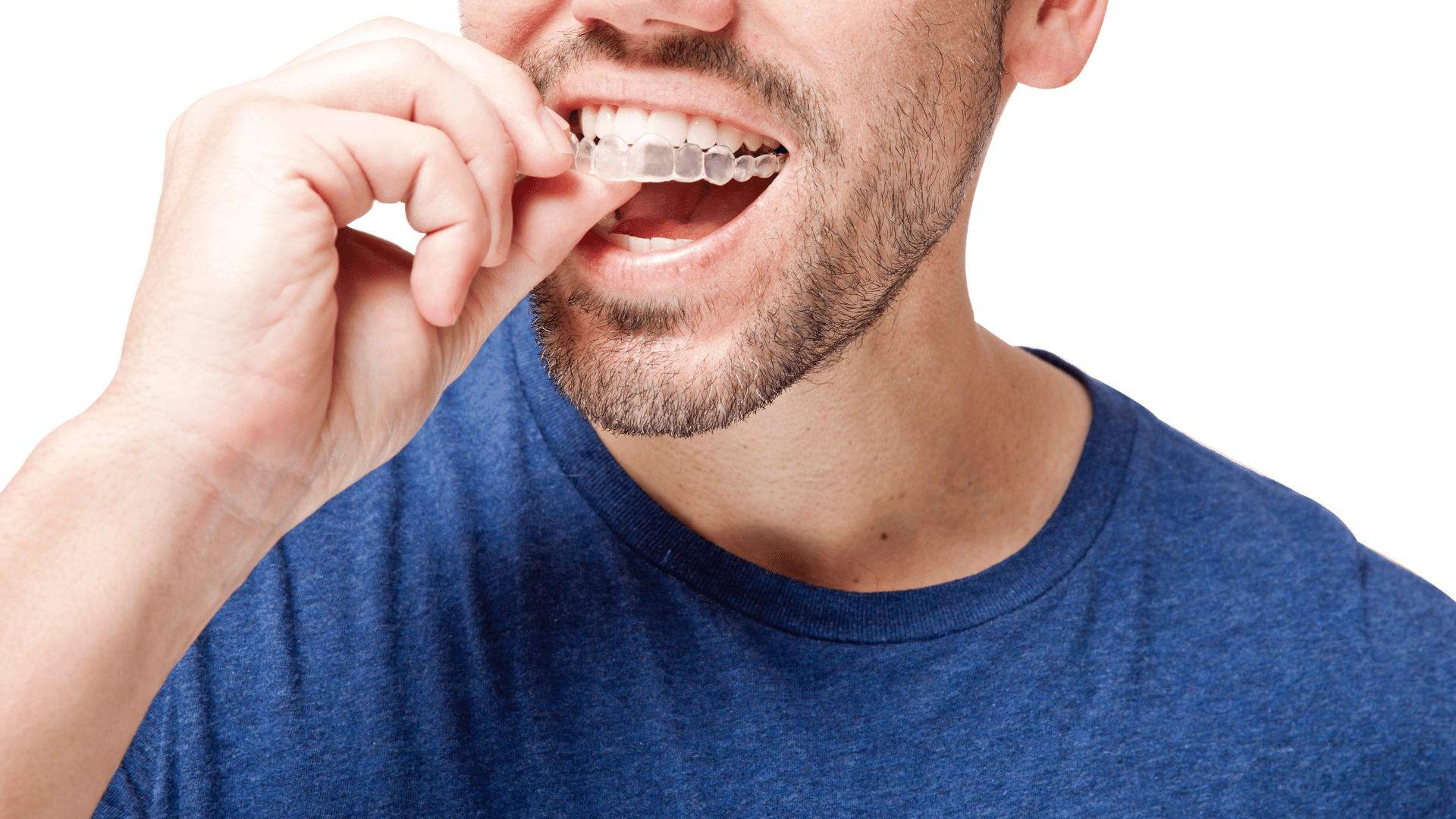 Discover the best clear braces in London at the lowest price with Buckingham Gate Orthodontics. Start your smile journey today!