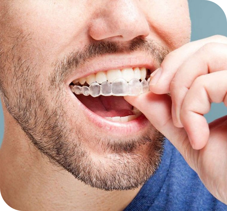 LP Invisalign 4