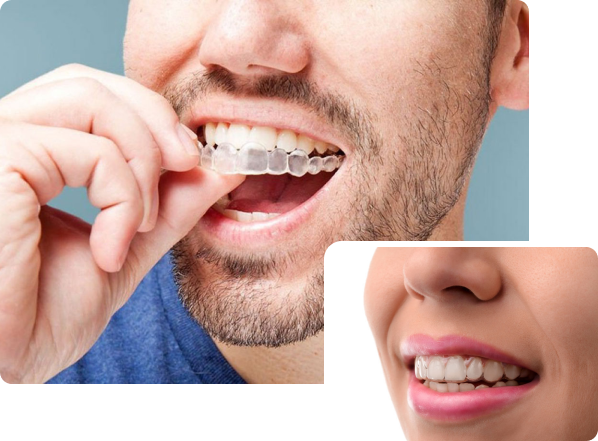 LP Invisalign 5