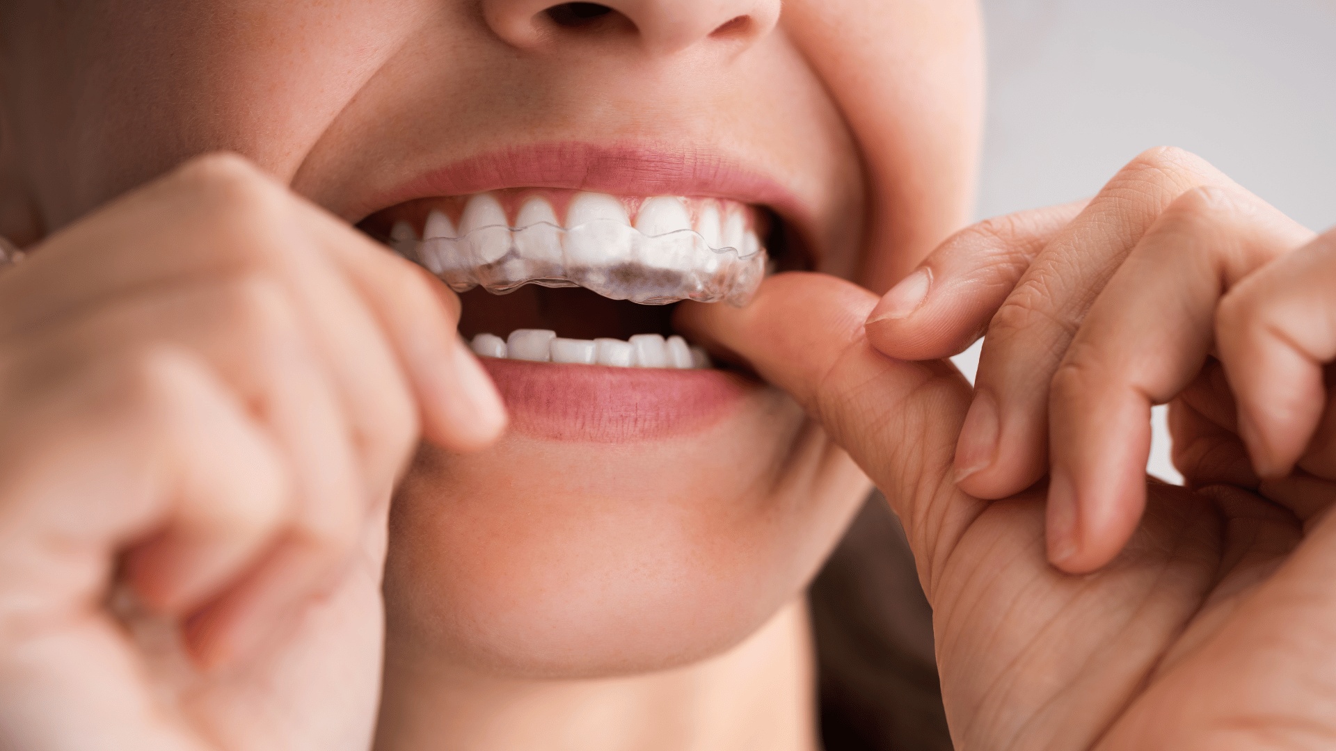 Discover affordable night guards and orthodontic solutions at Buckingham Gate Orthodontics in London. Your smile deserves the best care!