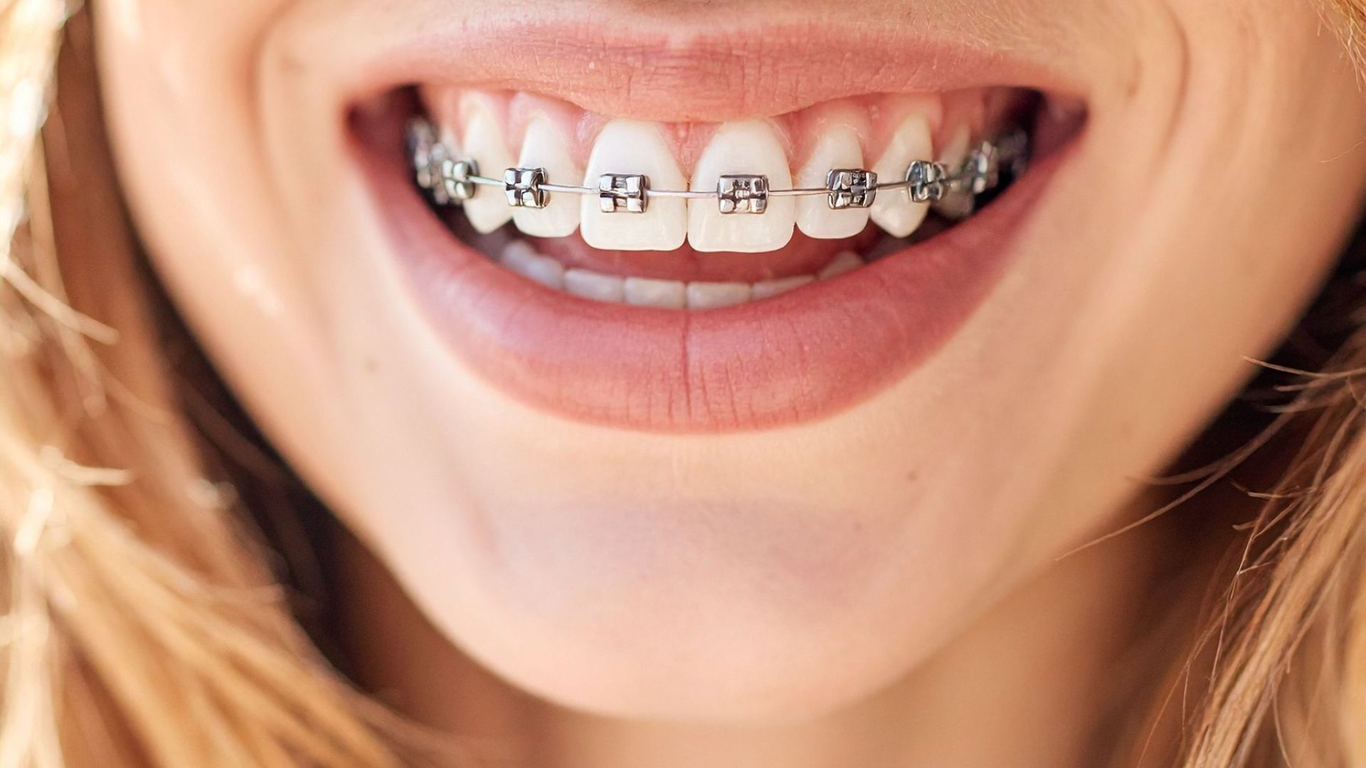 Discover the best fixed braces in London at the lowest prices! Book your appointment at Buckingham Gate Orthodontics today!