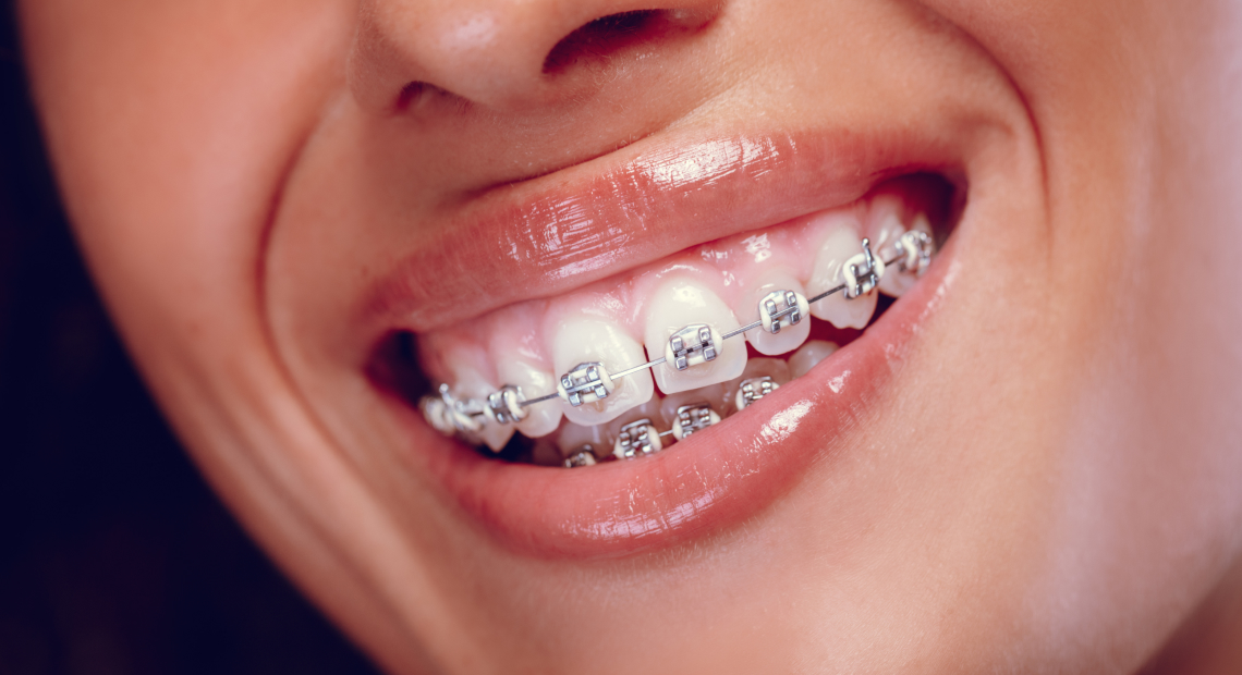 LP Braces in London