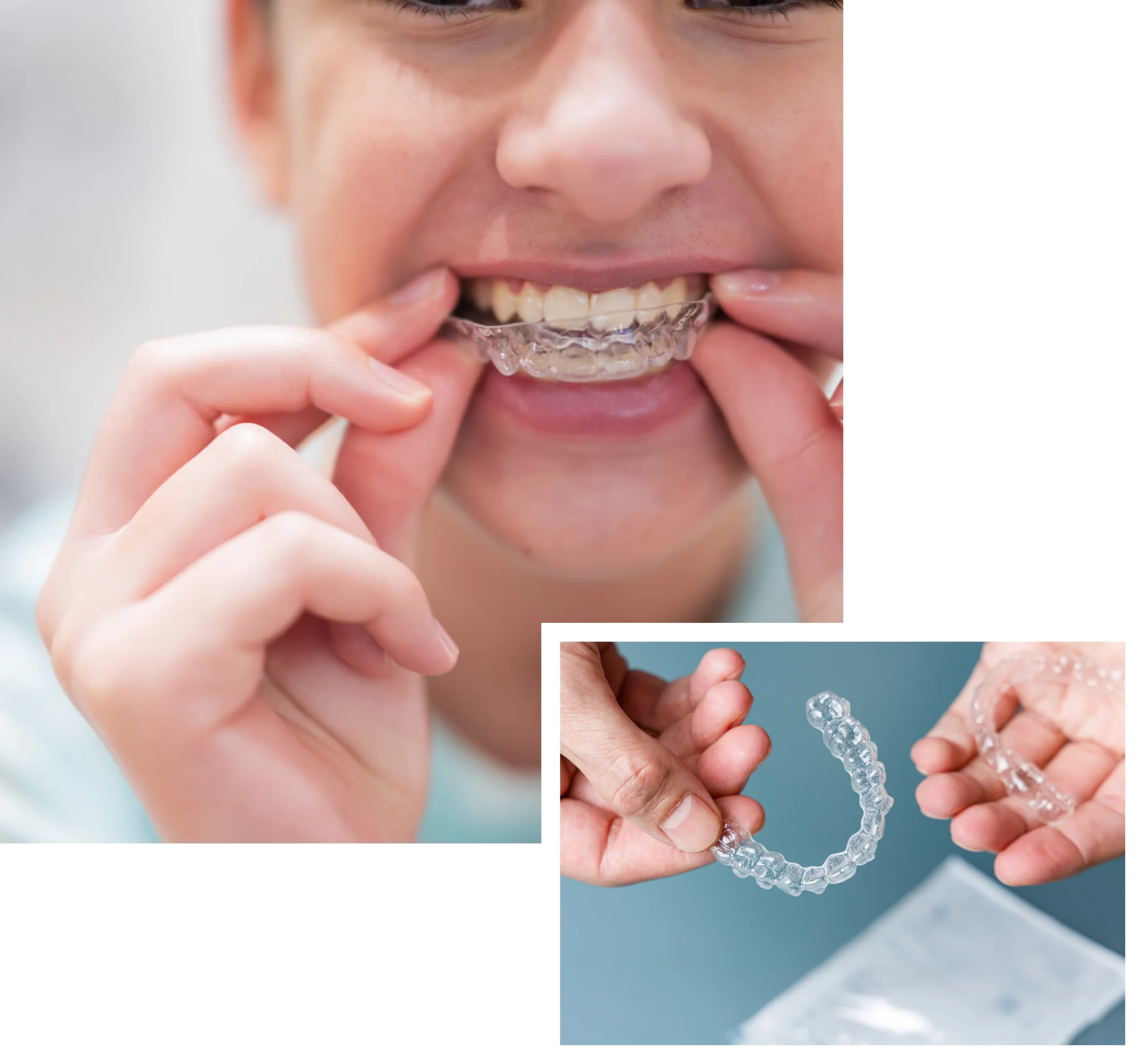 Invisalign Top Provider in London [2024]