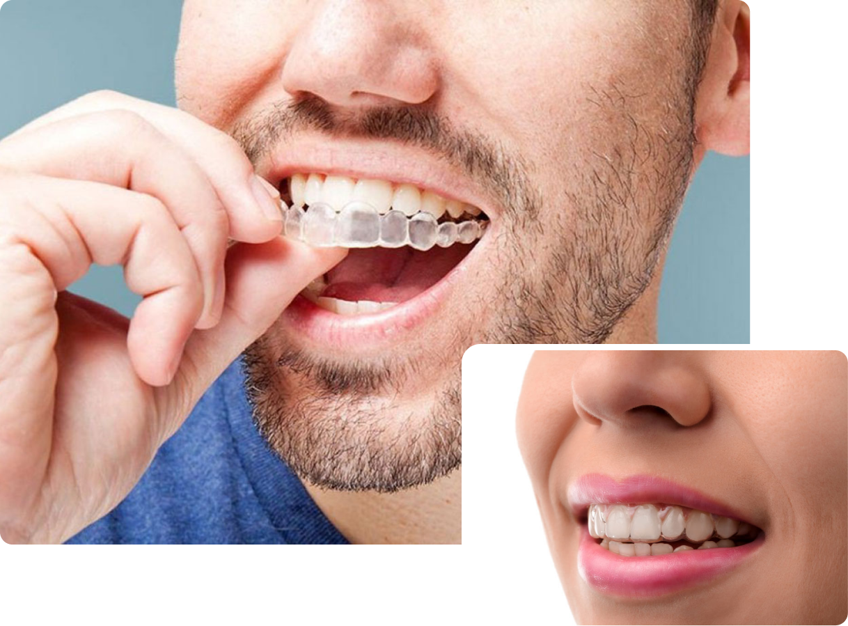 Invisalign in London at Buckingham Gate Orthodontics - V1