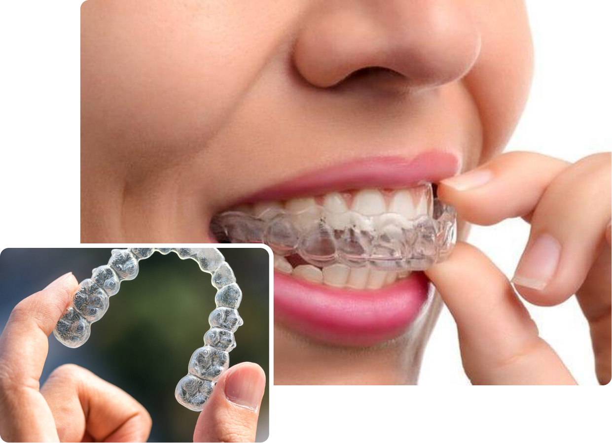 Invisalign in London at Buckingham Gate Orthodontics - V1