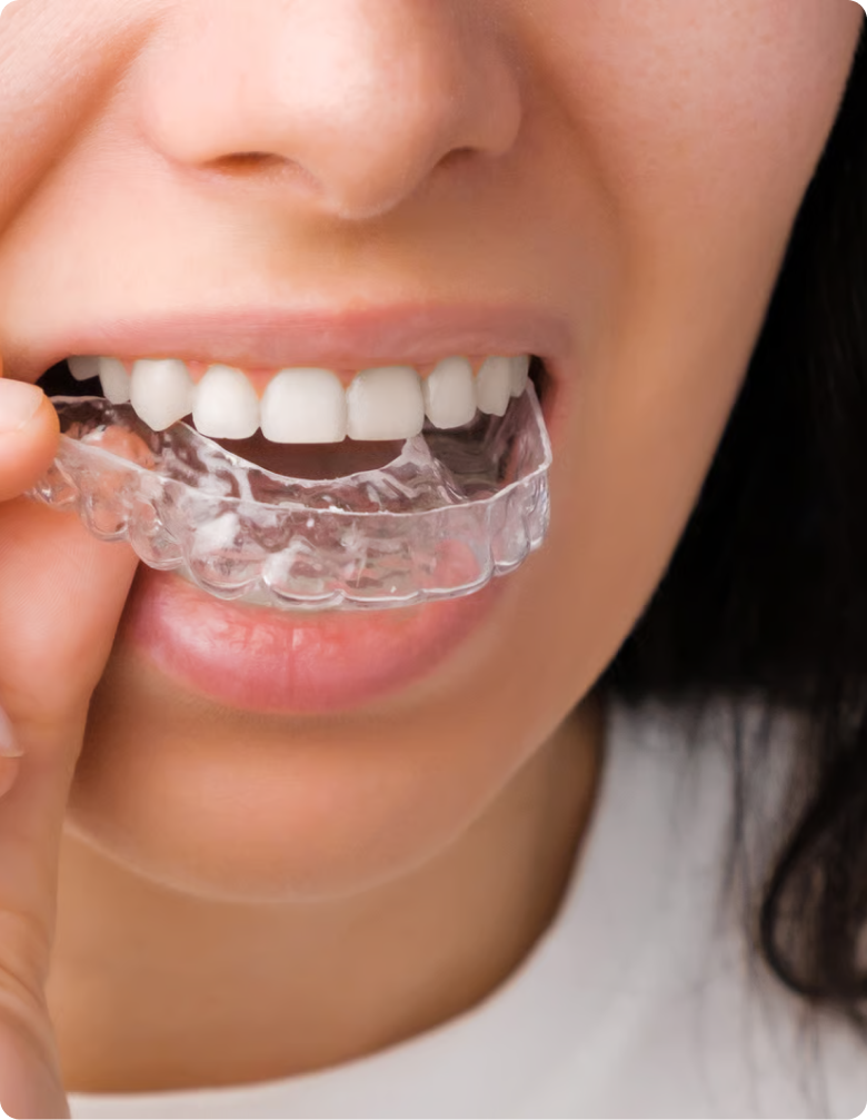 Invisalign in London at Buckingham Gate Orthodontics - V1
