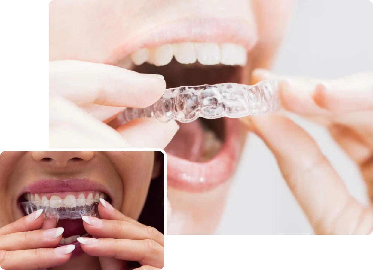 Invisalign in London at Buckingham Gate Orthodontics - V1