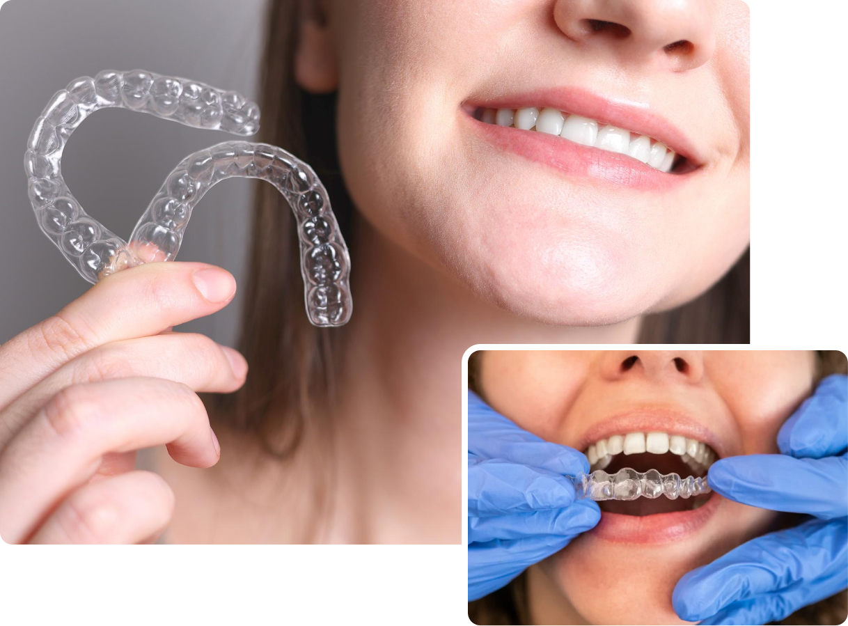 Invisalign in London at Buckingham Gate Orthodontics - V1