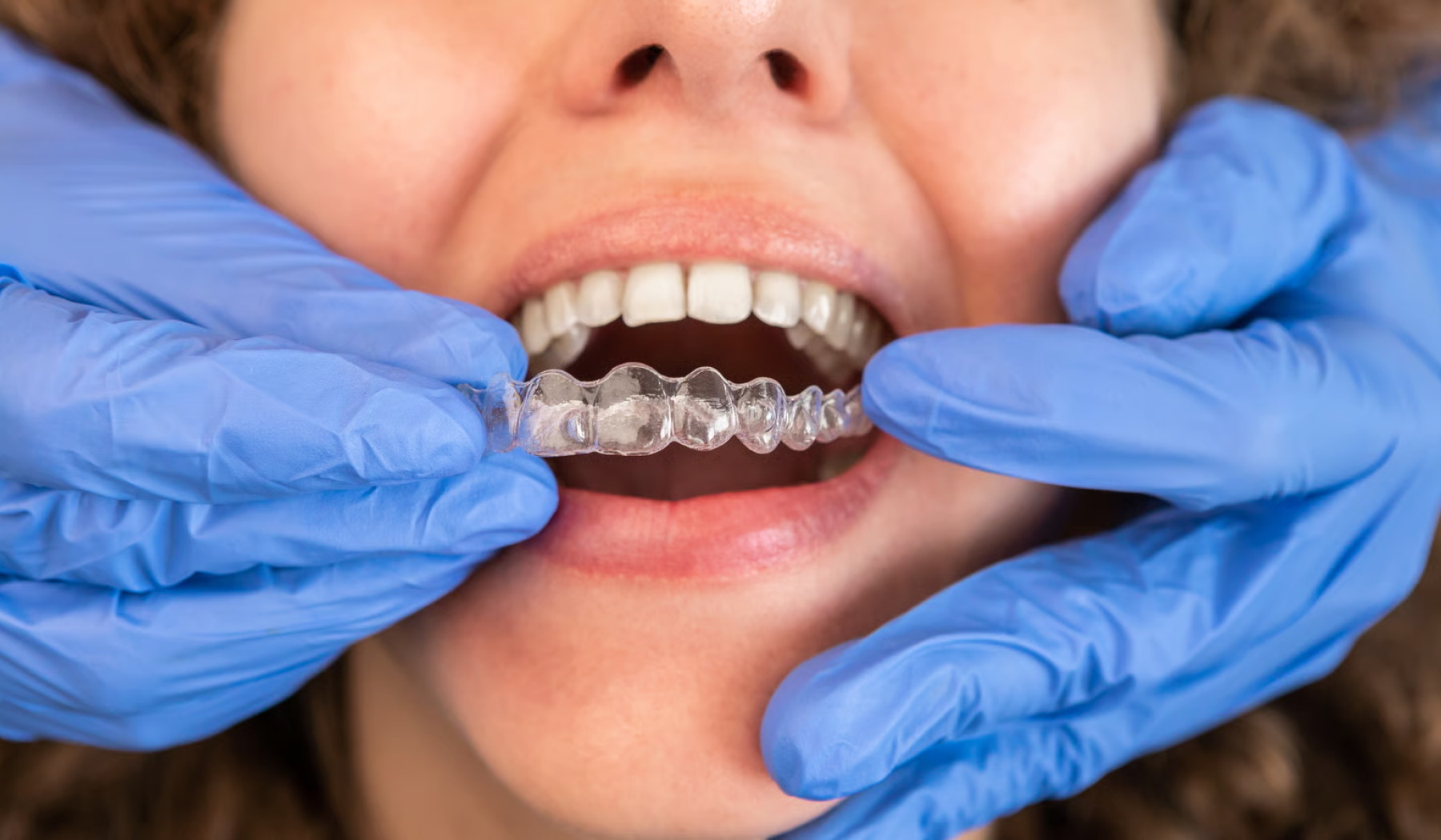 Invisalign in London at Buckingham Gate Orthodontics - V1