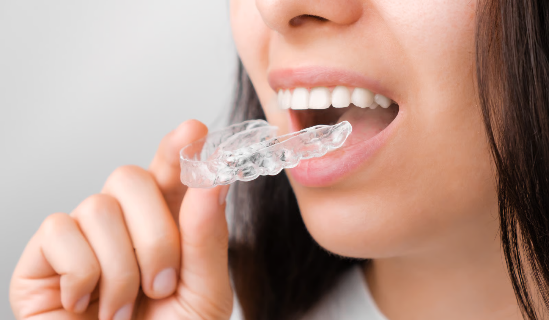 Invisalign in London at Buckingham Gate Orthodontics - V1