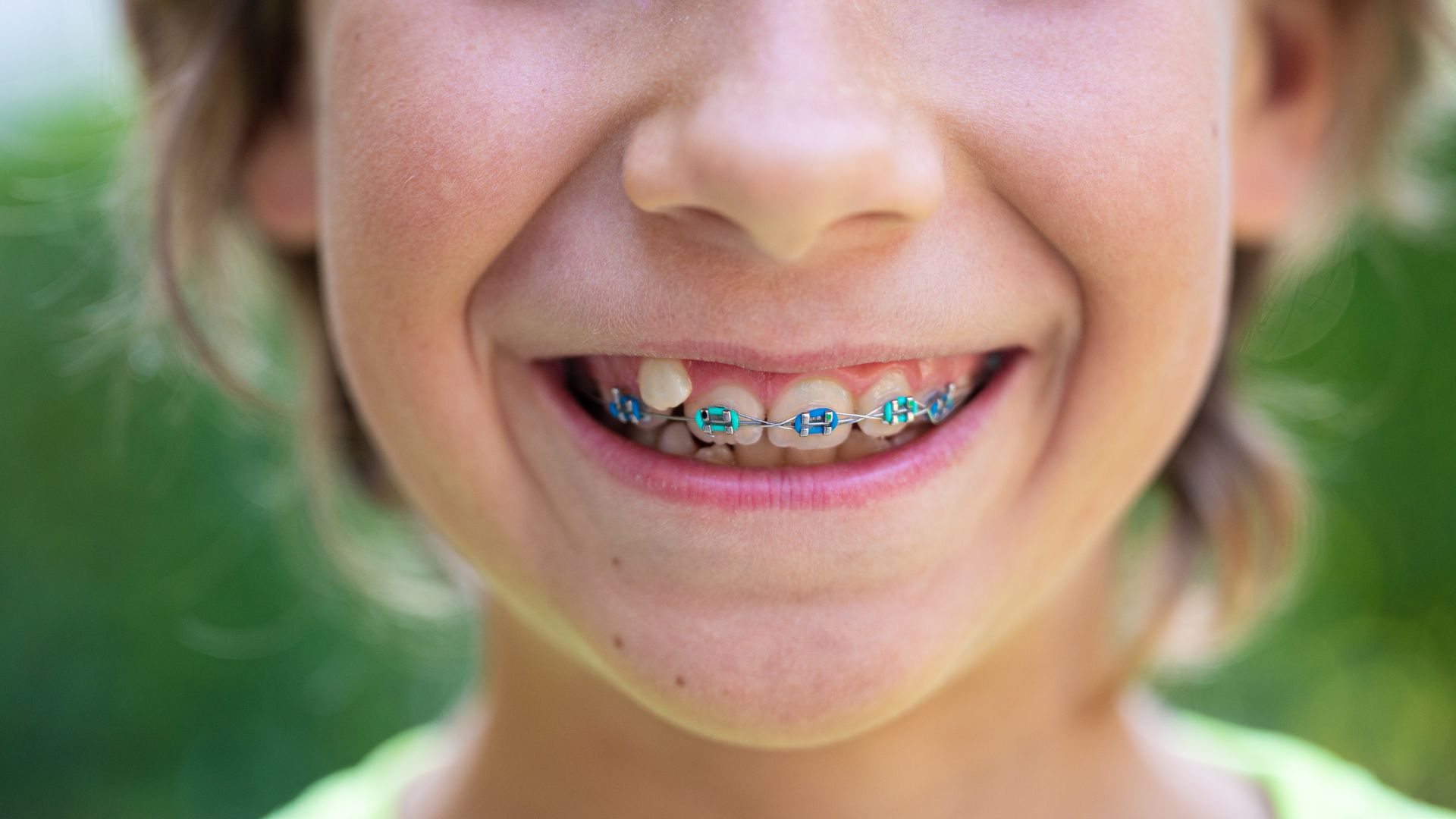 Discover the best braces for children in London at Buckingham Gate Orthodontics with affordable options and exceptional care.