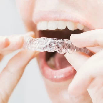 BGO Buckingham Gate Orthodontics - Dentist in London - Invisalign (10)